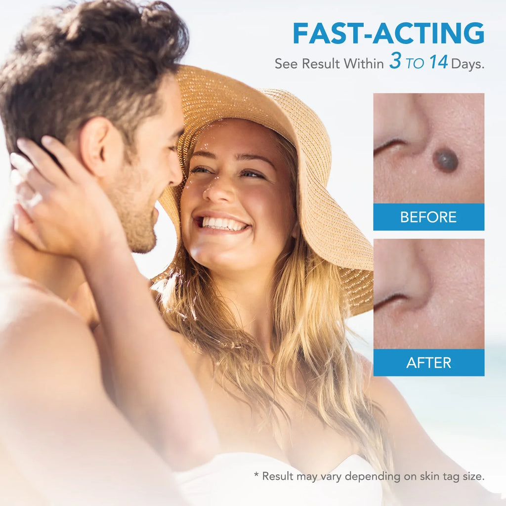 2 IN 1 Auto Micro Skin Tag Remover Device Standard And Micro Skin Tag Removal Kit Adult Mole Wart Remover Face Care Beauty Tools